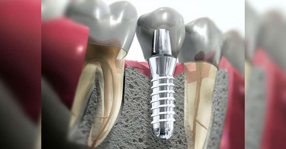 Co jest lepsze - szpilka czy implant? Wszystkie pułapki implantacji zębów! Są piekielne minusy ... /  Choroby