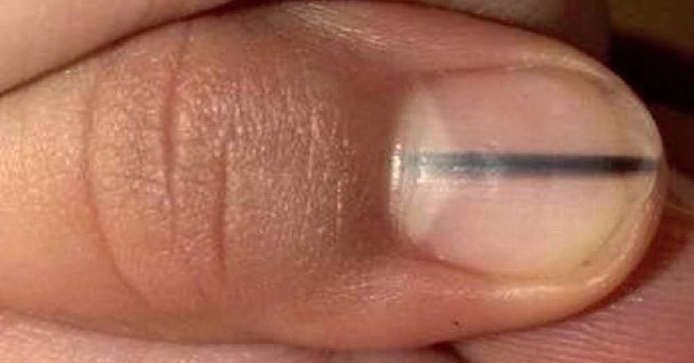 Tamne pruge na noktima - strašni znak! Onkolozi upozoravaju ... /  žene