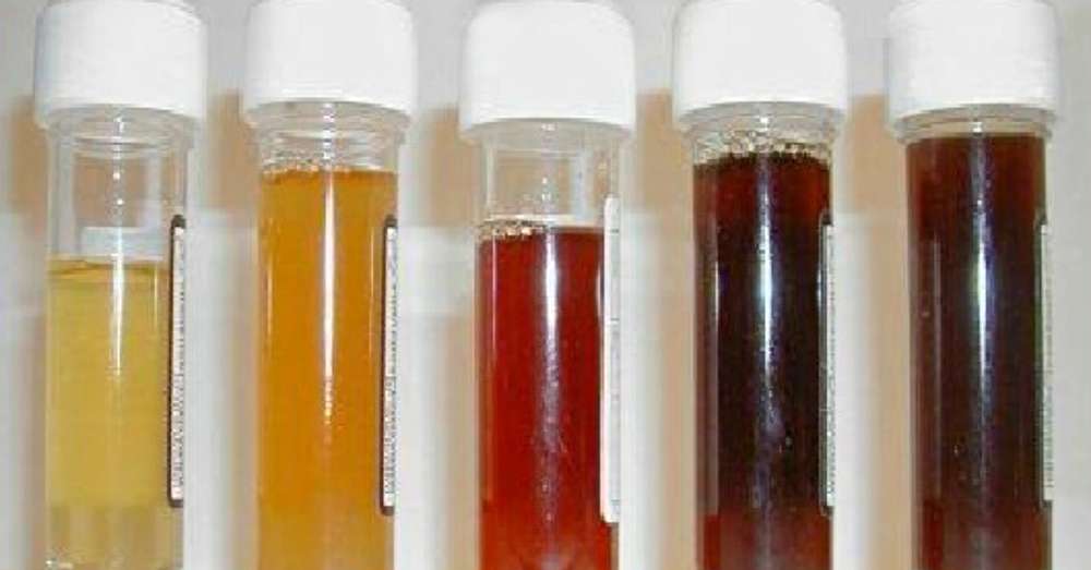 Kakšna je barva urina od cistitisa do raka. Pomembne informacije o stanju telesa. /  Analize