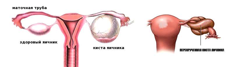 Киста у женщины психосоматика. Киста фаллопиевой трубы.