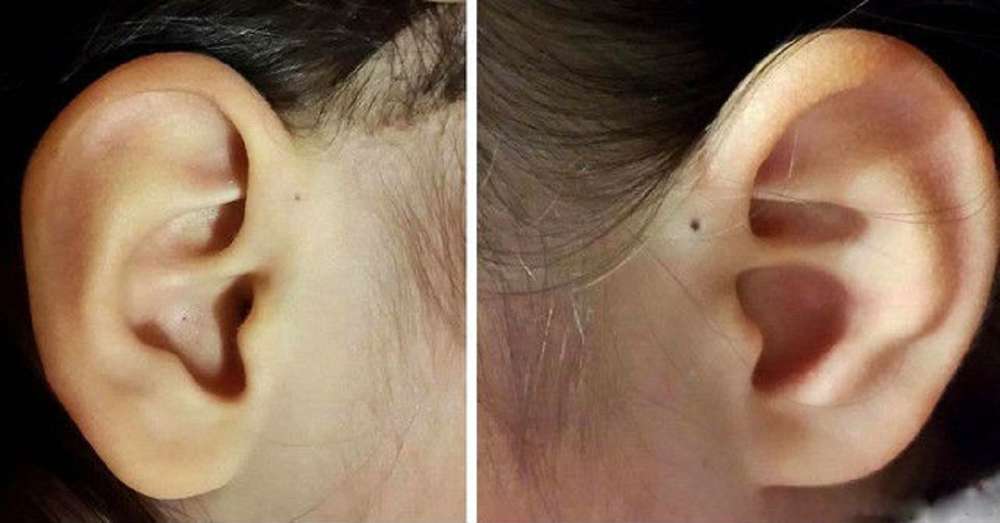 Zagrożenie dla zdrowia! Dlatego niektórzy ludzie mają taką dziurę w uchu. /  Choroby