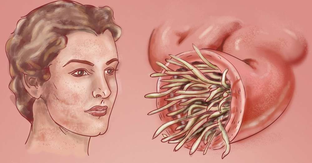 Лікарі-паразитологи б'ють на сполох! 95% населення заражені паразитами ... /  хвороби