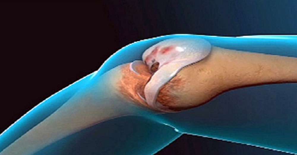 Lekári sú šokovaní týmto nástrojom zlepšujú štruktúru kostného tkaniva a obnovujú kĺby! /  choroba