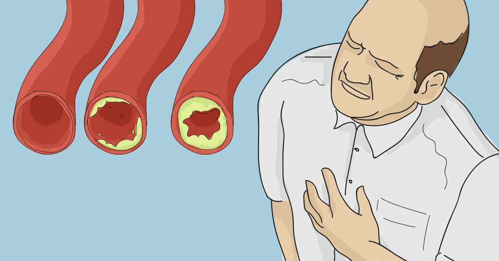 15 најбољих производа за чишћење артерија и спречавање инфаркта миокарда живи дуже! /  Болести