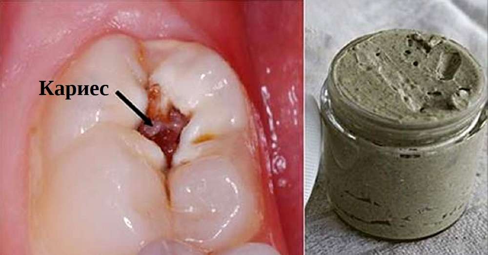 Domače zobna pasta za zdravljenje kariesa, krepitev dlesni in beljenje zob. /  Higiena