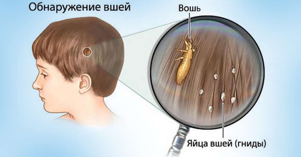 Efektívnejším prostriedkom nie je nájsť ani v lekárni! Parazitovia vyparujú, len si umyte vlasy ... /  choroba