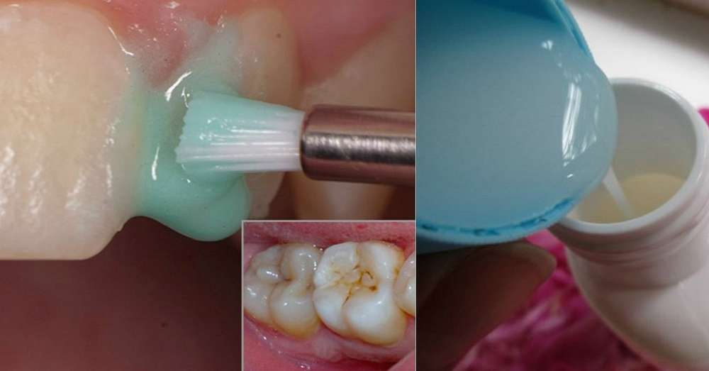 Ефективне відбілювання зубів в домашніх умовах краще професійного чищення! /  зуби