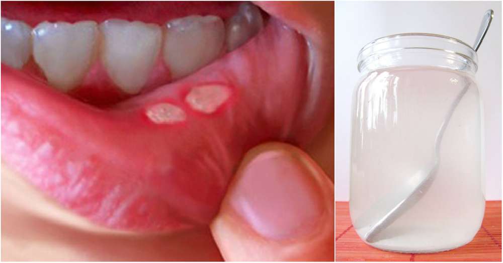 Jak leczyć zapalenie jamy ustnej w domu oznacza, że ​​działa bezbłędnie. /  Bakterie