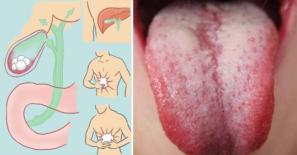 Okamžite si prečítajte tento článok, ak ste si všimli rovnakú plaketu na jazyku! /  choroba