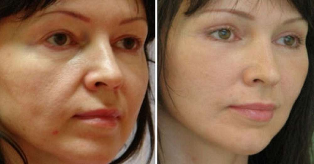 Sagnuo obraze? Saznajte više o učinkovitim metodama korekcije lica! /  glina