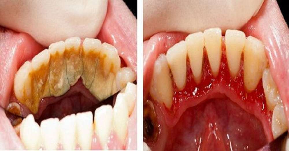Дізнайся, як легко видалити зубний камінь і зробити посмішку білосніжною! Навіть не сподівалася на такий ефект ... /  зуби