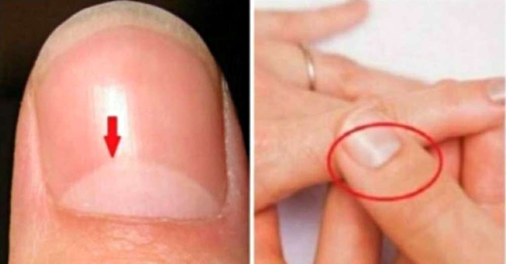 Dlatego białe dziury mogą zniknąć u nasady paznokcia, nie przegap niepokojącego objawu! /  Choroby