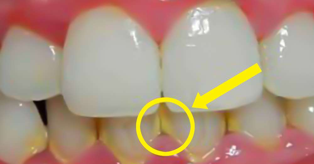 Зубний наліт зникне через 5 хвилин! Скасувала похід до стоматолога. /  зуби