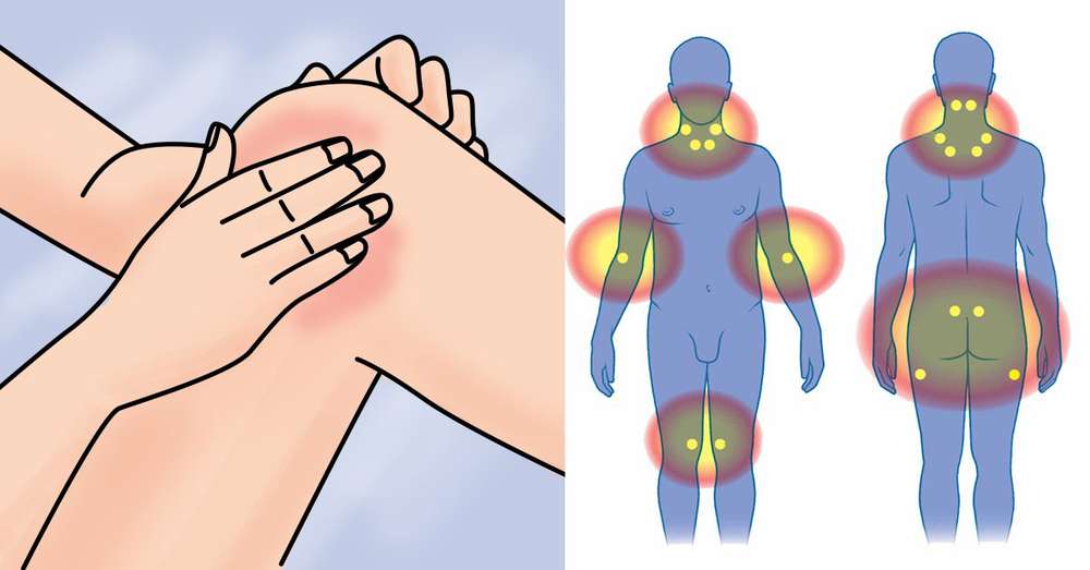 Koja je razlika između običnih bolova u mišićima i fibromijalgije? Potrebne informacije! /  Bol