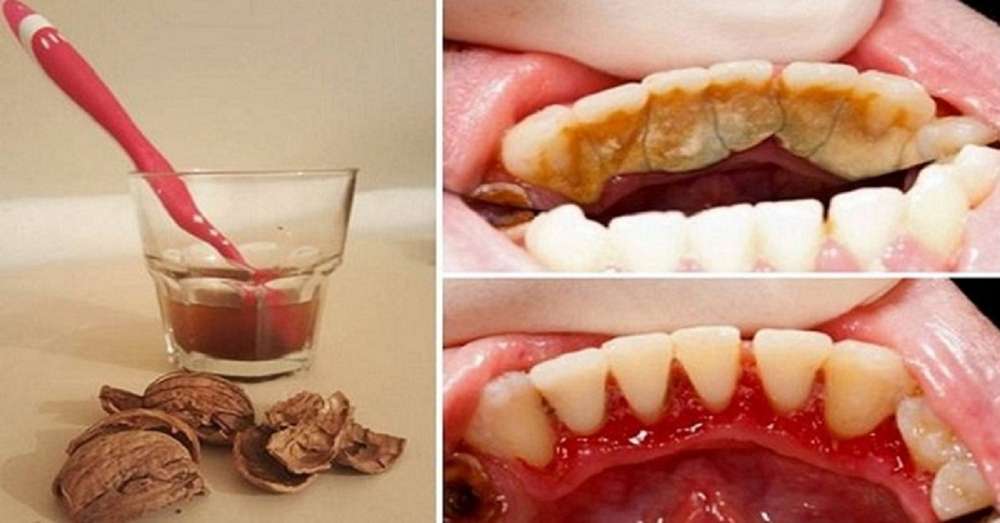 Як позбутися від зубного каменю за допомогою 1 простого засобу. /  зуби