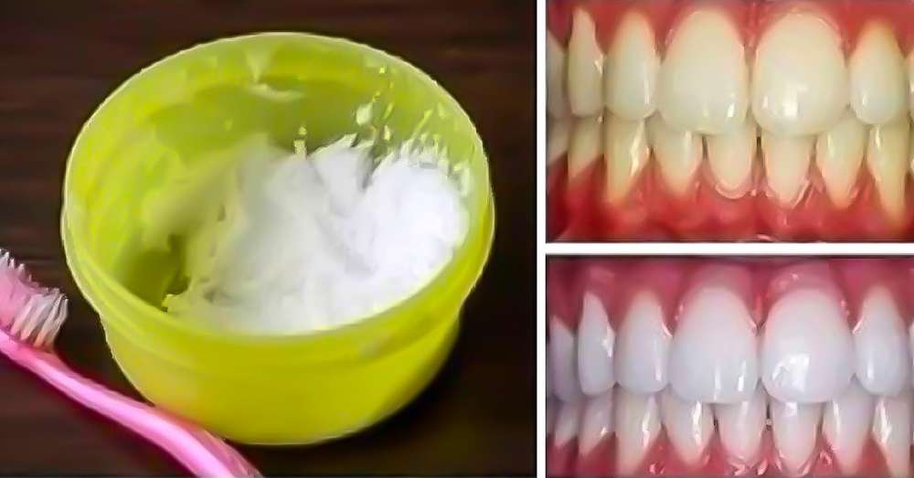 Kako pobegniti zobe doma 3 minute 100% rezultat! /  Zobje