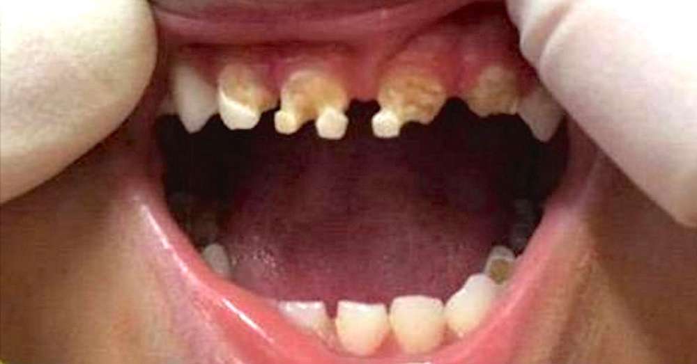 Ko je zdravnik videl zobe 3-letnega otroka, je prosil mamo samo eno vprašanje ... /  Bakterije