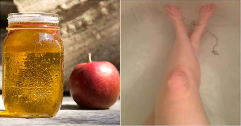Вона набрала ванну і додала 500 мл яблучного оцту. Через 30 хвилин її шкіру було не впізнати! /  запалення