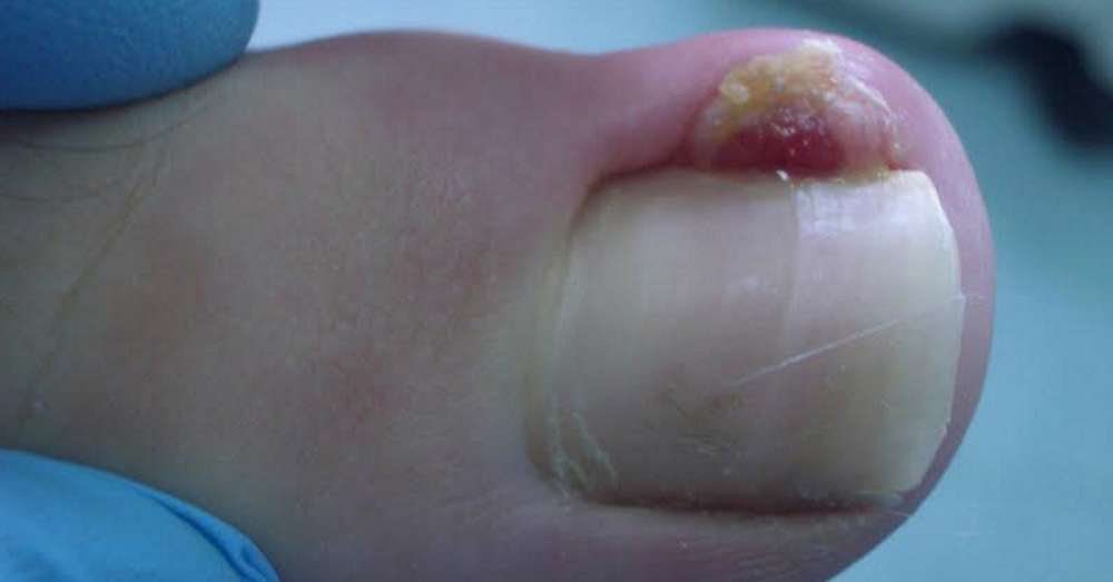 Ostrożnie, ta choroba może doprowadzić do amputacji palców! Poznaj całą prawdę o wrastającym paznokciu. /  Skóra