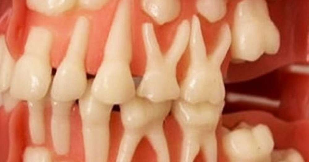 Razvijajte nove zube u 9 tjedana postupku koji je moguć u bilo kojoj dobi! /  Bol