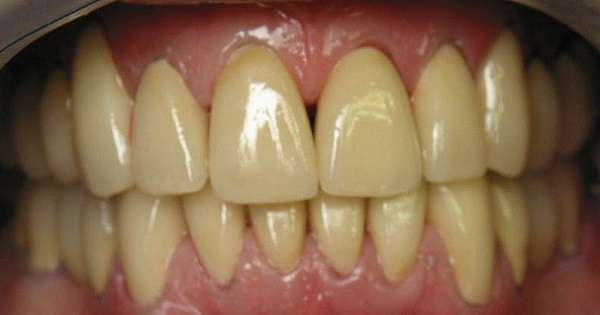 Природни производи за избељивање зуба. Вратите свој сјај назад у свој осмех! /  Зуби