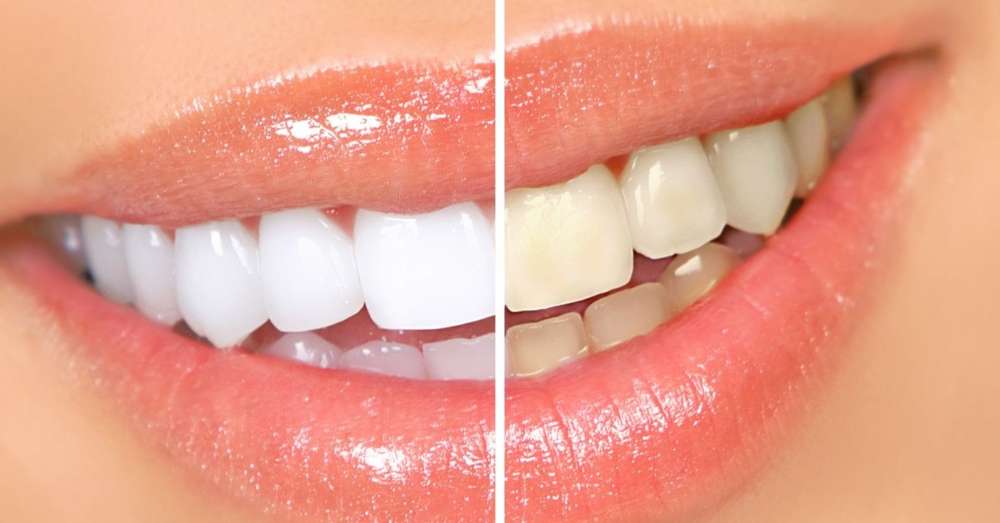 Bieliť zuby doma je ľahké! Populárne spôsoby, ako sa zbaviť žltej smalty. /  banány