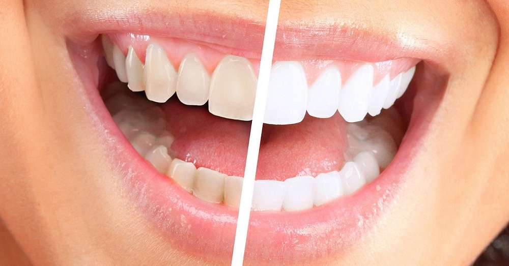 Usmievajte sa na milión, ako bieť zuby doma za 3 minúty. /  zuby