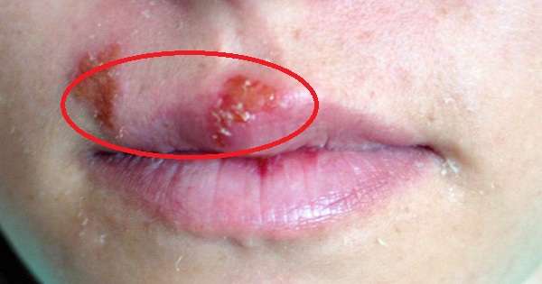 Herpes virus nije samo blaga bolest kože. Zapravo, to je opasnije nego što ste mislili! /  bolest